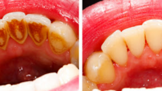 Dëmtimet e dhëmbëve i luftoni me këtë…