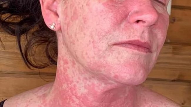 Gruaja pëson alergji nga vaksina e AstraZeneca