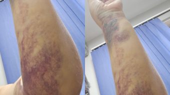 “Kam dhimbje dhe krahun e nxirë, mjeku&hellip;
