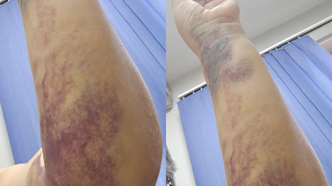 “Kam dhimbje dhe krahun e nxirë, mjeku&hellip;